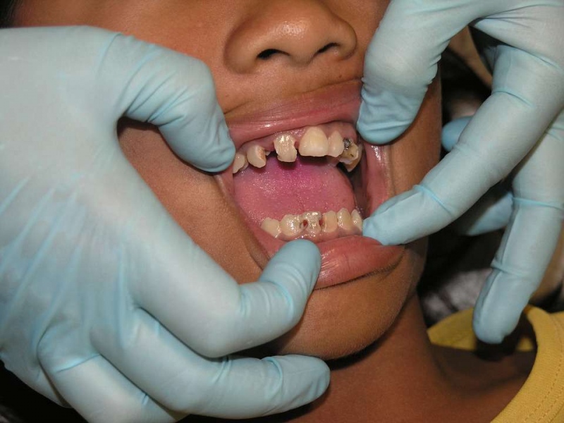 火牙痛偏方快速止痛方法牙齿疼痛怎么办